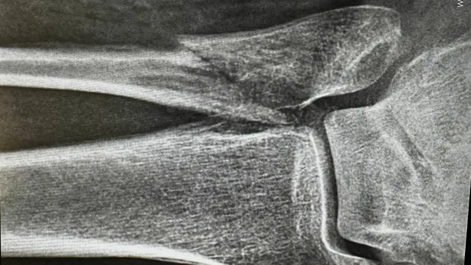 Motorcycle Accidents Resulting in Broken Bones or Scarring
